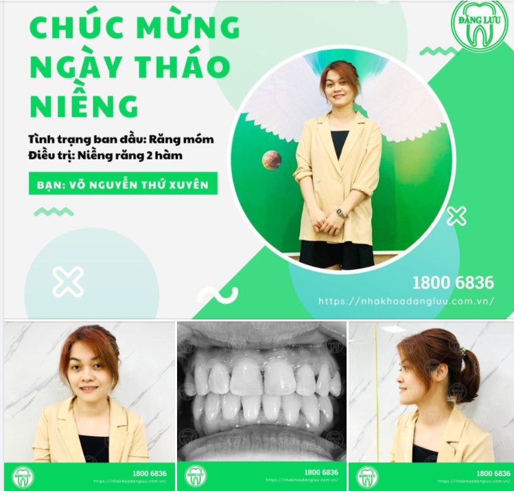 Chúng ta nhất định sẽ tự tin hơn khi chúng ta có một nụ cười đẹp