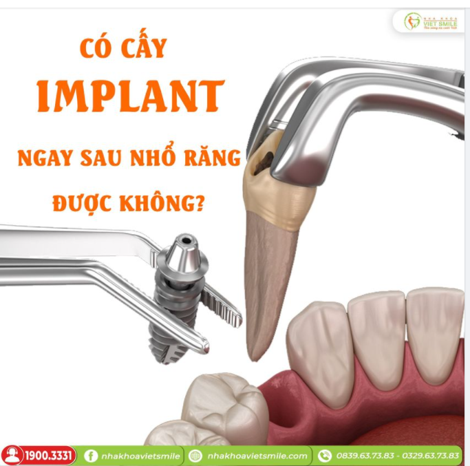 CÓ CẤY IMPLANT NGAY SAU NHỔ RĂNG ĐƯỢC KHÔNG?