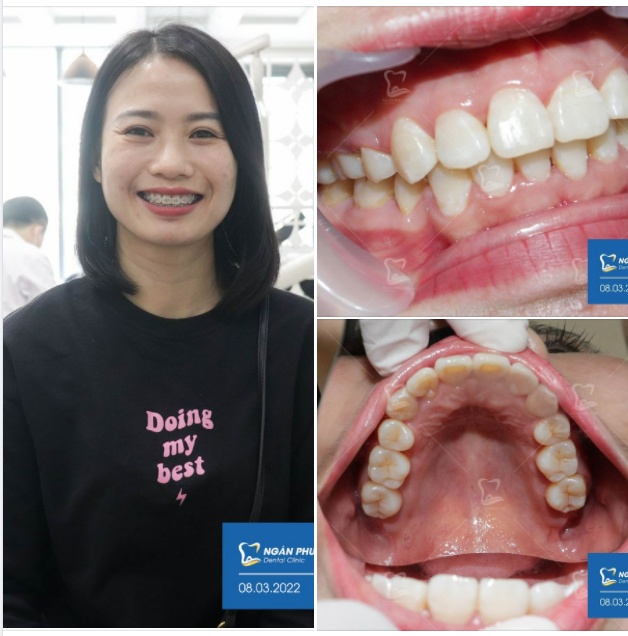 Có công đeo niềng, có ngày có hàm răng xinh