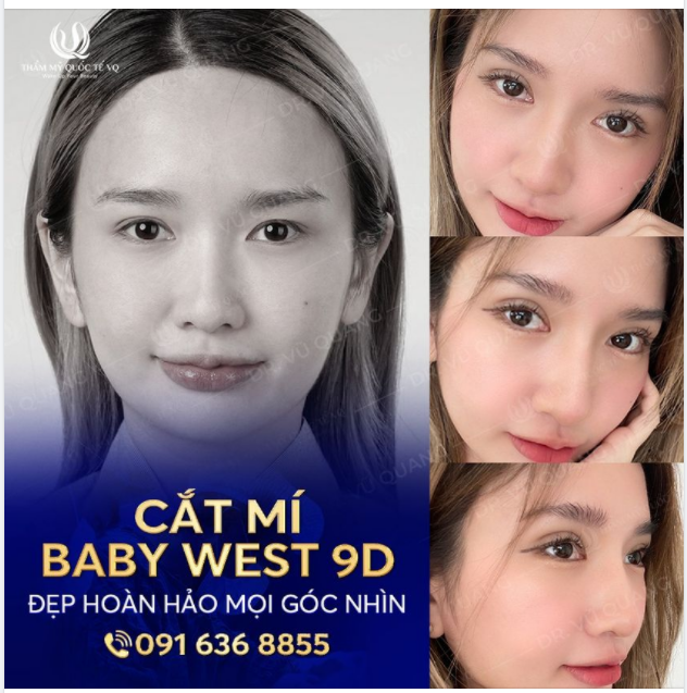 Cô gái Vượt gần 3000km từ Hàn Quốc về Việt Nam để Cắt mí Baby West 9D và cái kết bất ngờ.