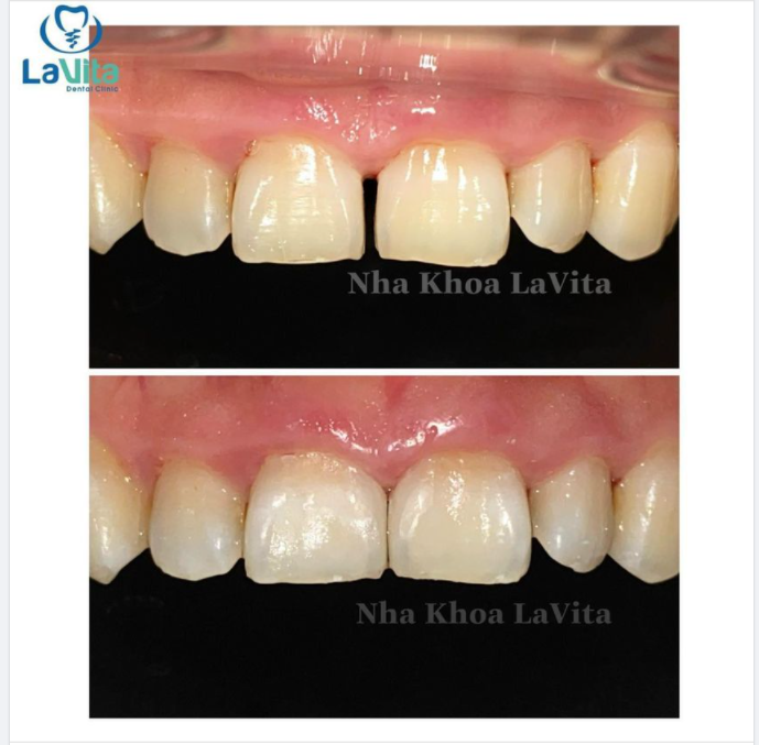 Có rất nhiều khách hàng của Lavita tâm sự rằng vì nghĩ rằng RĂNG CỬA THƯA chỉ có thể khắc phục bằng phương pháp Niềng răng/bọc răng sứ nên đành chấp nhận “xấu xí” vì chưa sắp xếp được thời gian, chưa đủ kinh phí thực hiện.