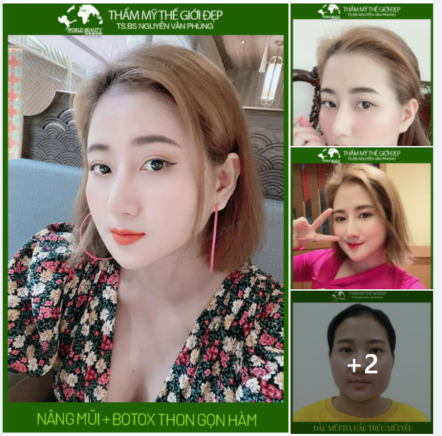 Combo LỘT XÁC N.âng mũi cấu trúc + Botox thon gọn hàm giúp loại bỏ cùng lúc