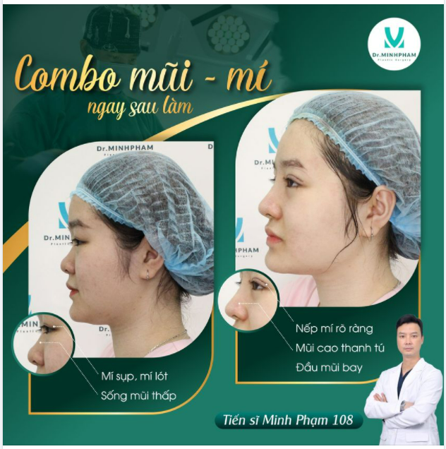 COMBO MŨI - MÍ ĐÃ ĐẸP PHẢI ĐẸP CẢ ĐÔI