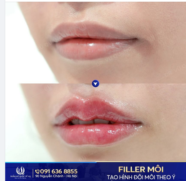 CỰC HOT ​​​​​​​Tạo hình môi căng mọng, quyến rũ tại VQ