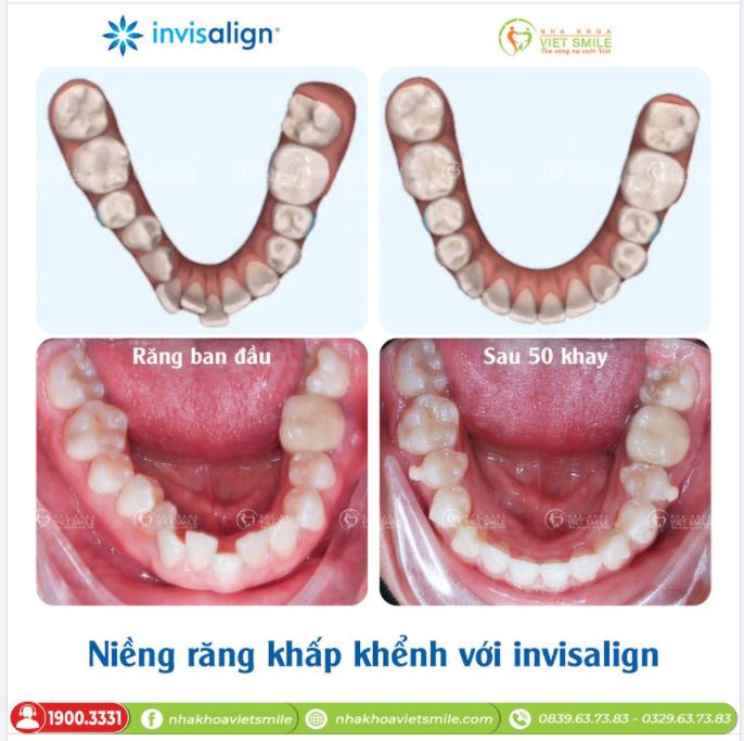 CÙNG INVISALIGN CHINH PHỤC NỤ CƯỜI HOÀN HẢO