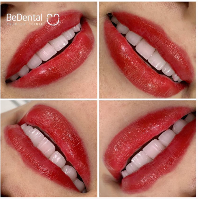 Cũng là răng sứ nhưng răng sứ làm ở Bedental nó đẹp lắm!
