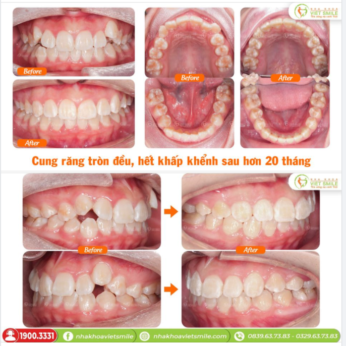 CUNG RĂNG TRÒN ĐỀU, HẾT KHẤP KHỂNH SAU HƠN 20 THÁNG