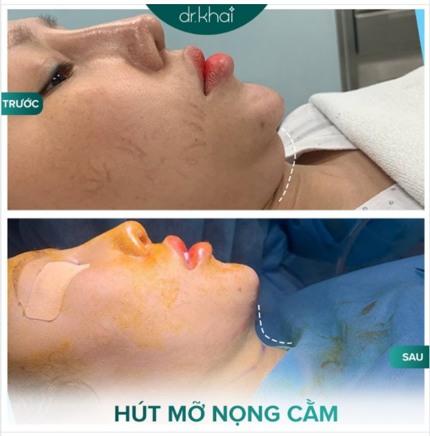 ĐÃ XONG CA HÚT MỠ NỌNG CẰM