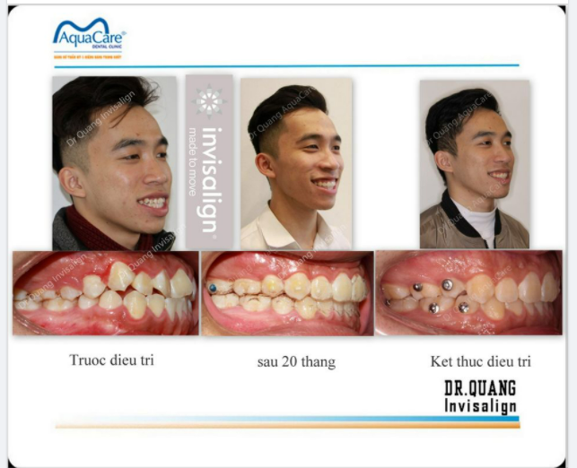 ĐÀN ÔNG VIỆT NAM ĐẸP TRAI THỨ HAI THẾ GIỚI – CHỈ SAU BRASIL