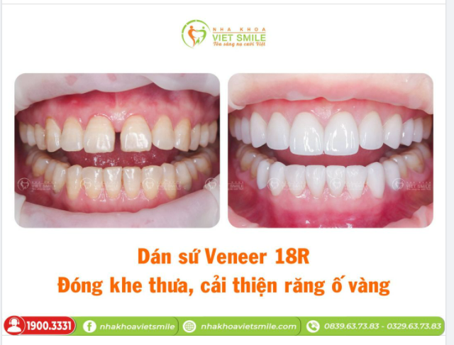 DÁN SỨ VENEER 18R - ĐÓNG KHE THƯA, CẢI THIỆN RĂNG Ố VÀNG