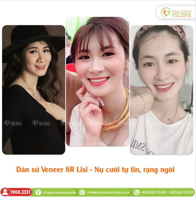 DÁN SỨ VENEER CHO NỤ CƯỜI TỰ TIN, RẠNG NGỜI