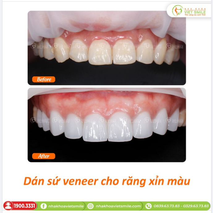 DÁN SỨ VENEER KHẮC PHỤC RĂNG Ố VÀNG, XỈN MÀU