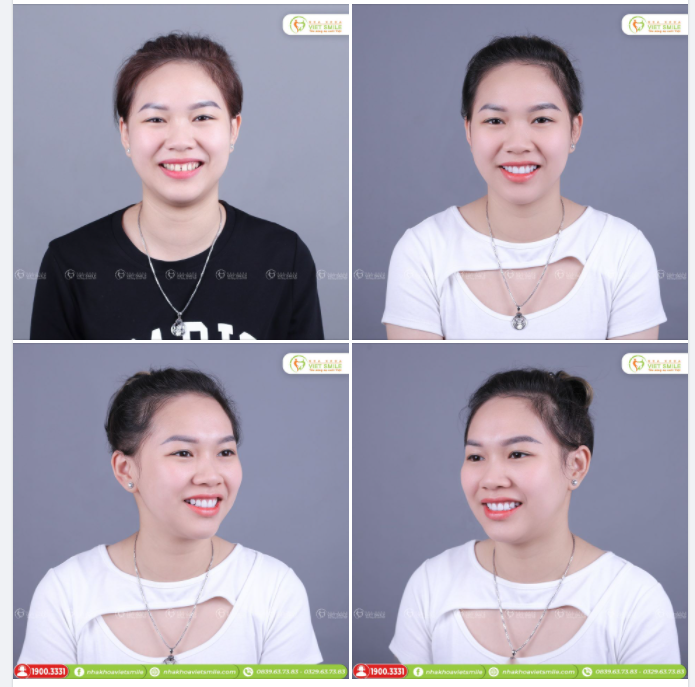 DÁN SỨ VENEER KHẮC PHỤC TÌNH TRẠNG RĂNG THƯA