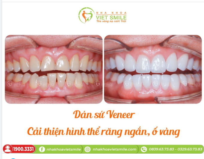 DÁN SỨ VENEER - LỚP ÁO HOÀN HẢO CHO NỤ CƯỜI