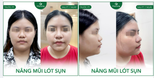 Dáng mũi cũ thấp, thiếu sóng và khá thô, nhưng phẫu thuật nâng mũi lót sụn của Bs Khanh đã cải thiện đáng kể dáng mũi ấy