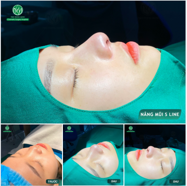 DÁNG MŨI ĐẸP CHO NGÀY MỚI