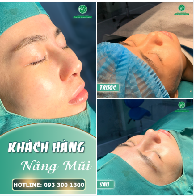 DÁNG MŨI ĐẸP CHUẨN - TỰ NHIÊN ĐẾN BẤT NGỜ