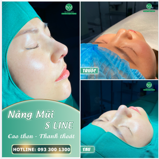 DÁNG MŨI S LINE - CHO NÀNG TỰ TIN ĐÓN LỄ