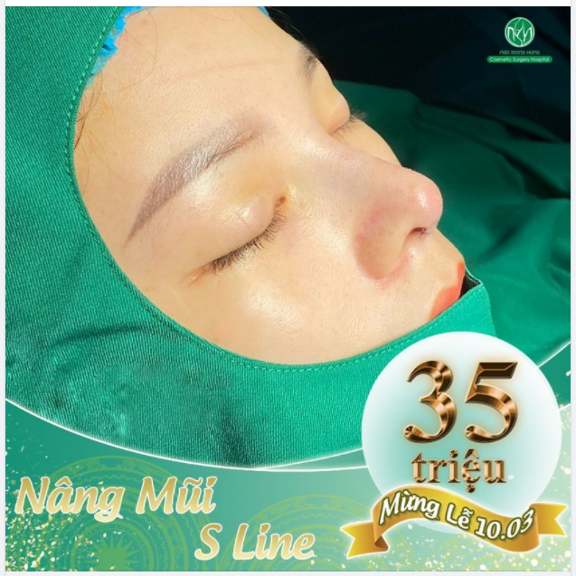 Dáng mũi S Line hoàn hảo từ đầu mũi đến cánh mũi, khắc phục mọi khuyết điểm