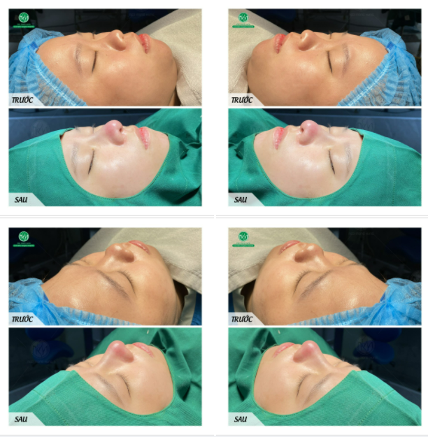 DÁNG MŨI S LINE MỚI NHẤT TẠI BVTM NGÔ MỘNG HÙNG