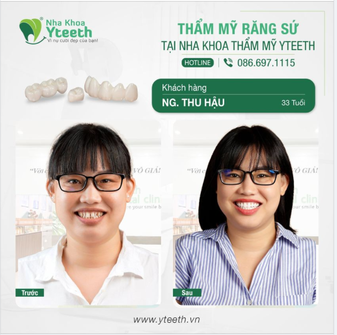 Đây là kết quả sau khi hoàn thiện của chị chị khách hàng 33 tuổi.