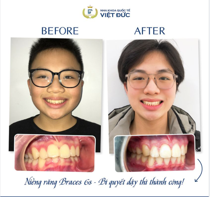 DẬY THÌ THÀNH CÔNG NHỜ NIỀNG RĂNG