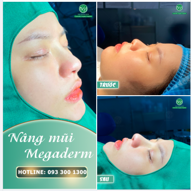 ĐẾN BVTM NGÔ MỘNG HÙNG LÀ CÓ NGAY MŨI XINH
