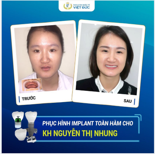 ĐEO HÀM THÁO LẮP NHIỀU ĐAU LẮM, KHÔNG ĂN ĐƯỢC, THƯỜNG XUYÊN PHẢI LÀM LẠI, RẤT TỐN KÉM.