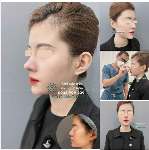 ĐẸP DỮ THẦN KHI CHỈ MỚI 2 TUẦN NÂNG MŨI CẤU TRÚC SỬA LẠI- ĐỘC QUYỀN ĐẦU MŨI CAO BAY THON GỌN chỉ có tại BSK