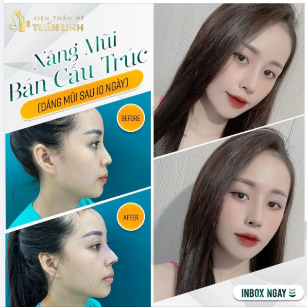 Diện mạo rạng rỡ, xinh đẹp ngút ngàn sau 10 ngày nâng mũi tại Tuân Linh