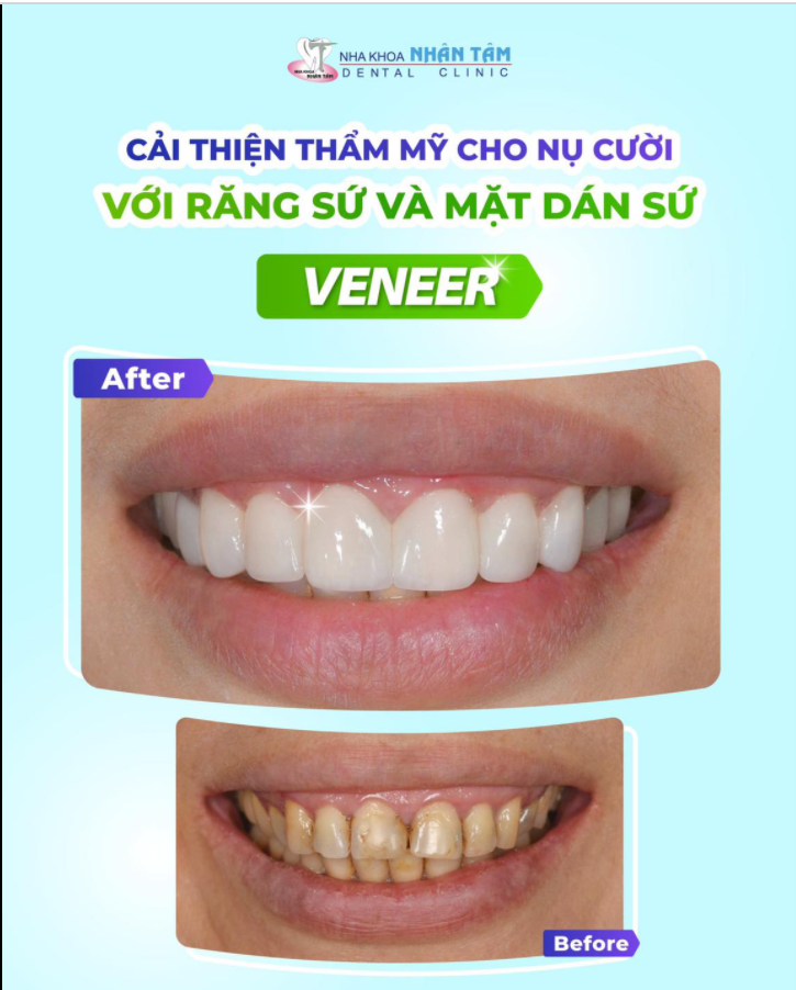 Điều trị bọc sứ thường được chỉ định cho các trường hợp răng đã sâu nặng, hư tủy, răng thưa, khấp khểnh nhẹ hoặc răng nhiễm tetracycline không thể tẩy trắng.