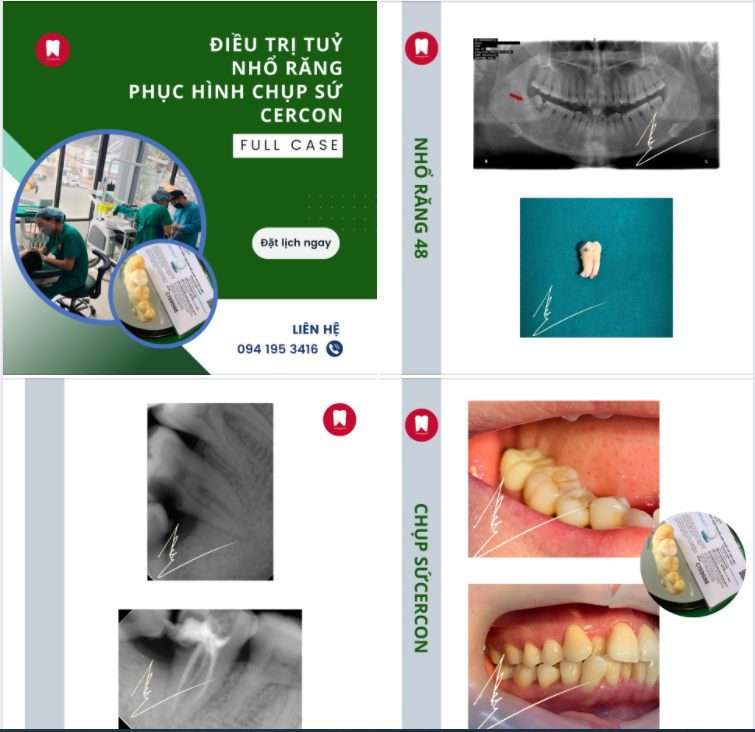 ĐIỀU TRỊ TUỶ - NHỔ RĂNG - PHỤC HÌNH CHỤP SỨ CERCON