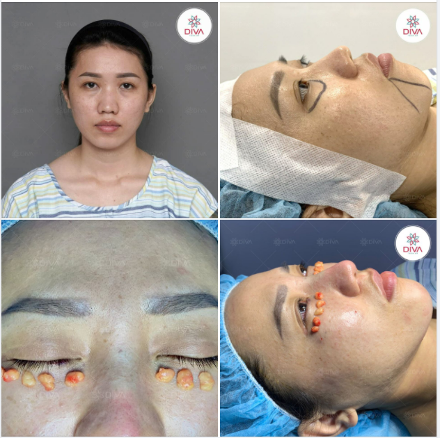 DIVA THỰC HIỆN COMBO 4 DỊCH VỤ THẨM MỸ CHO KHÁCH
