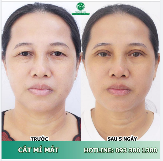 ĐÔI MẮT 2 MÍ TRẺ TRUNG CHO KH U60