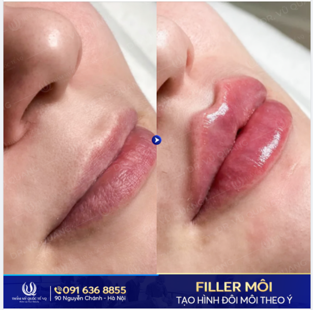 Đôi môi mỏng kém duyên.