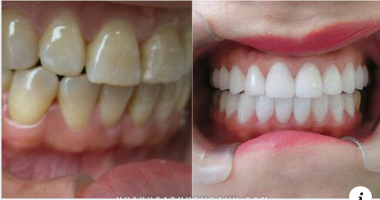 Đối tượng nào nên bọc răng sứ ?