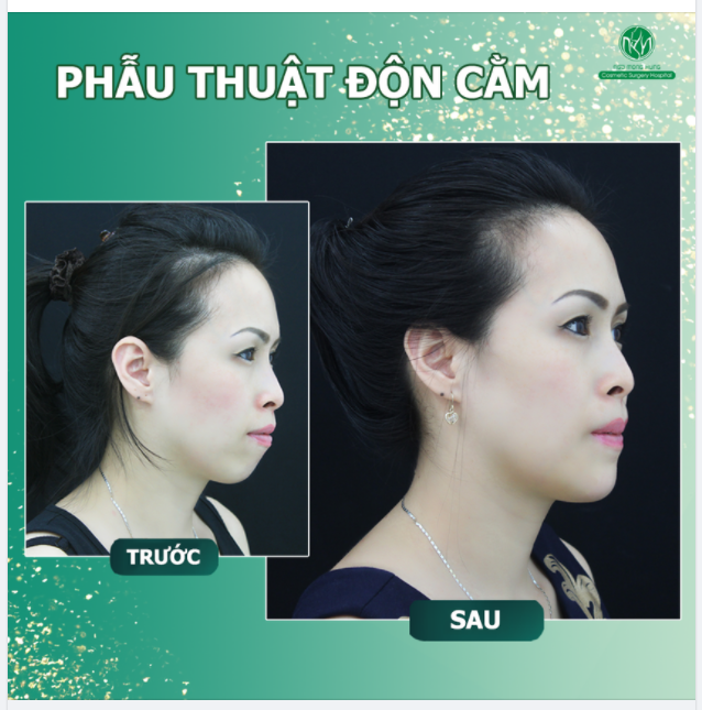 ĐỘN CẰM V LINE - ĐẸP SANG THẦN THÁI