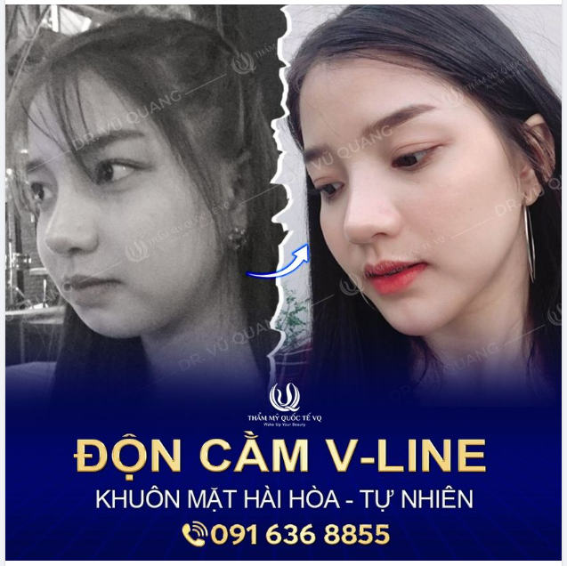 ĐỘN CẰM VLINE - Giải pháp nhanh chóng sở hữu dáng cằm như ý
