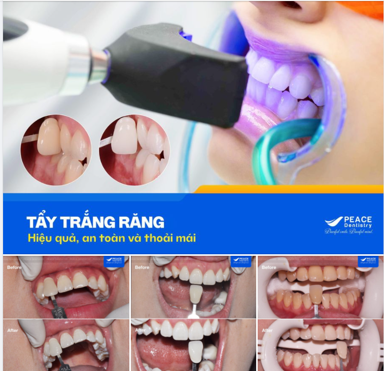 Đơn giản, nhẹ nhàng chỉ trong khoảng 90 phút, nhưng kết quả trắng sáng đủ để bạn hài lòng!