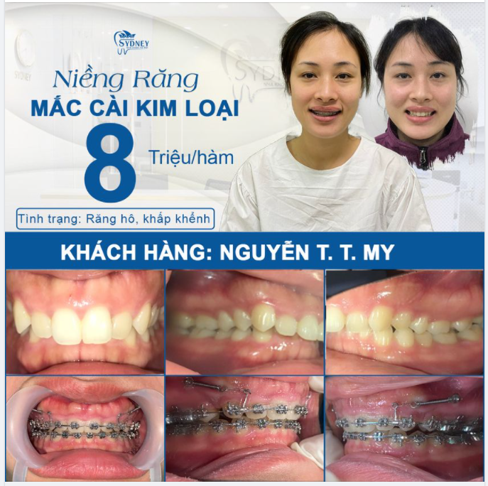 ĐỪNG BỎ QUA NẾU BẠN MUỐN TIẾT KIỆM TIỀN BẠC VÀ THỜI GIAN KHI NIỀNG RĂNG