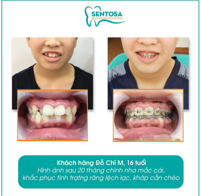 ĐỪNG ĐỂ HÀM RĂNG HÔ KHẤP KHỂNH ẢNH HƯỞNG ĐẾN SỰ TỰ TIN CỦA BẠN!!!