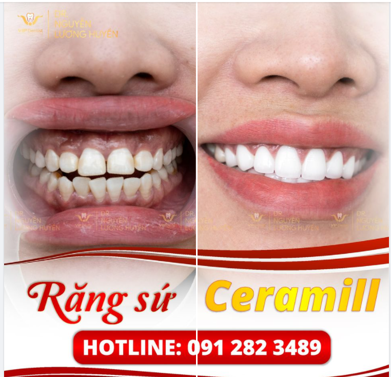 ĐƯỜNG CƯỜI CERAMILL SÁNG TỰ NHIÊN KHẮC PHỤC RĂNG KHẤP KHỂNH, SÂU KẼ