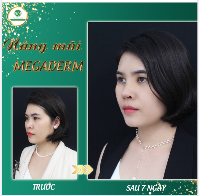 EM NÂNG MŨI BÂY GIỜ THÌ CÓ KỊP LỄ KHÔNG