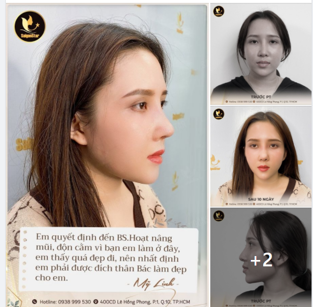 Em quyết định đến BS.Hoạt nâng mũi, độn cằm vì bạn em làm ở đây, em thấy quá đẹp đi, nên nhất định em phải được đích thân Bác làm đẹp cho em