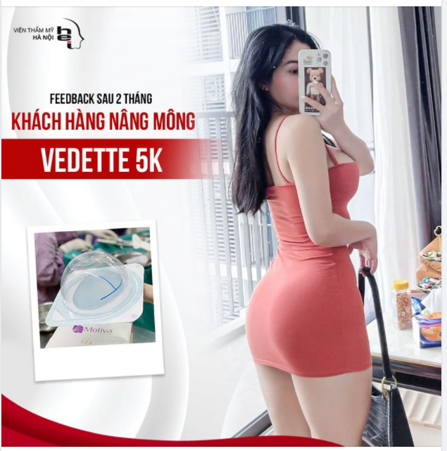 Feedback khách hàng nâng mông sau 2 tháng