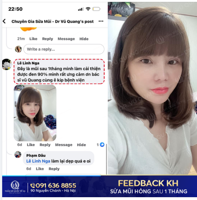 FEEDBACK SAU 1 tháng Sửa mũi cấu trúc Softline