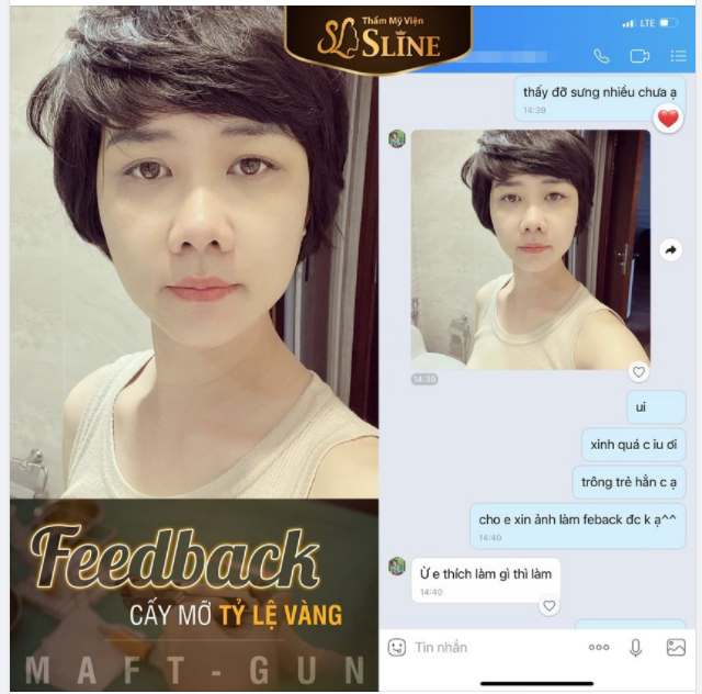 Feedback thực tế khách hàng. cấy mỡ tỷ lệ vàng với súng Maftgun.