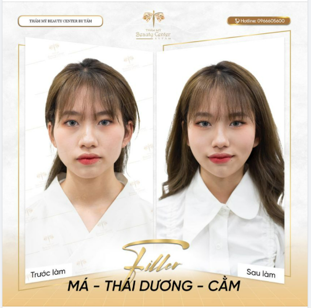 FILLER - Giải pháp cho nỗi khổ sợ đau, sợ phẫu thuật