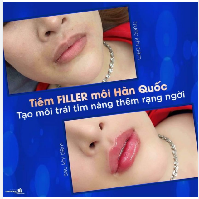 FILLER MÔI HÀN QUỐC - TẠO MÔI TRÁI TIM  NÀNG THÊM RẠNG NGỜI