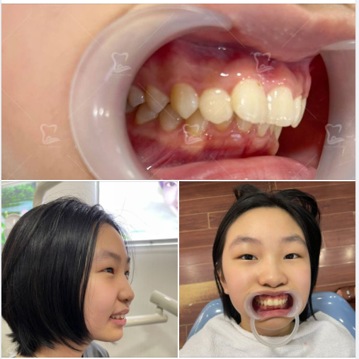 Gắn mắc cài sớm, rút ngắn con đường đến với nụ cười hoàn hảo